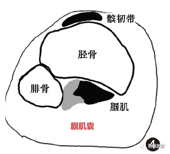 影像PPT - 膝关节滑囊解剖分组、示意图-4 影像PPT - 膝关节滑囊解剖分组、示意图-4