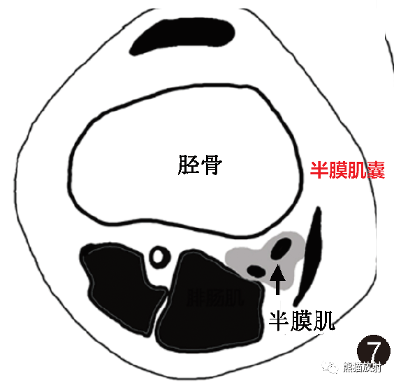 影像PPT - 膝关节滑囊解剖分组、示意图-7 影像PPT - 膝关节滑囊解剖分组、示意图-7