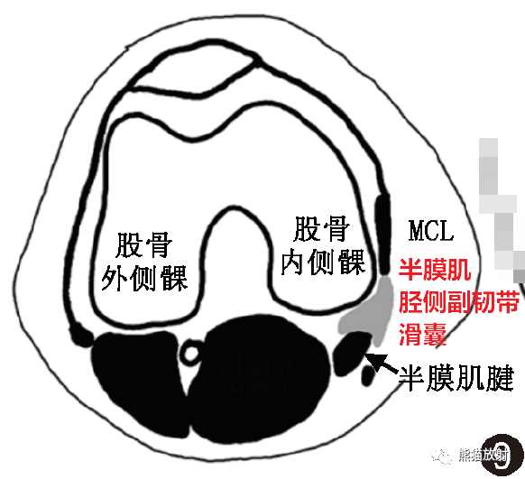 影像PPT - 膝关节滑囊解剖分组、示意图-9 影像PPT - 膝关节滑囊解剖分组、示意图-9