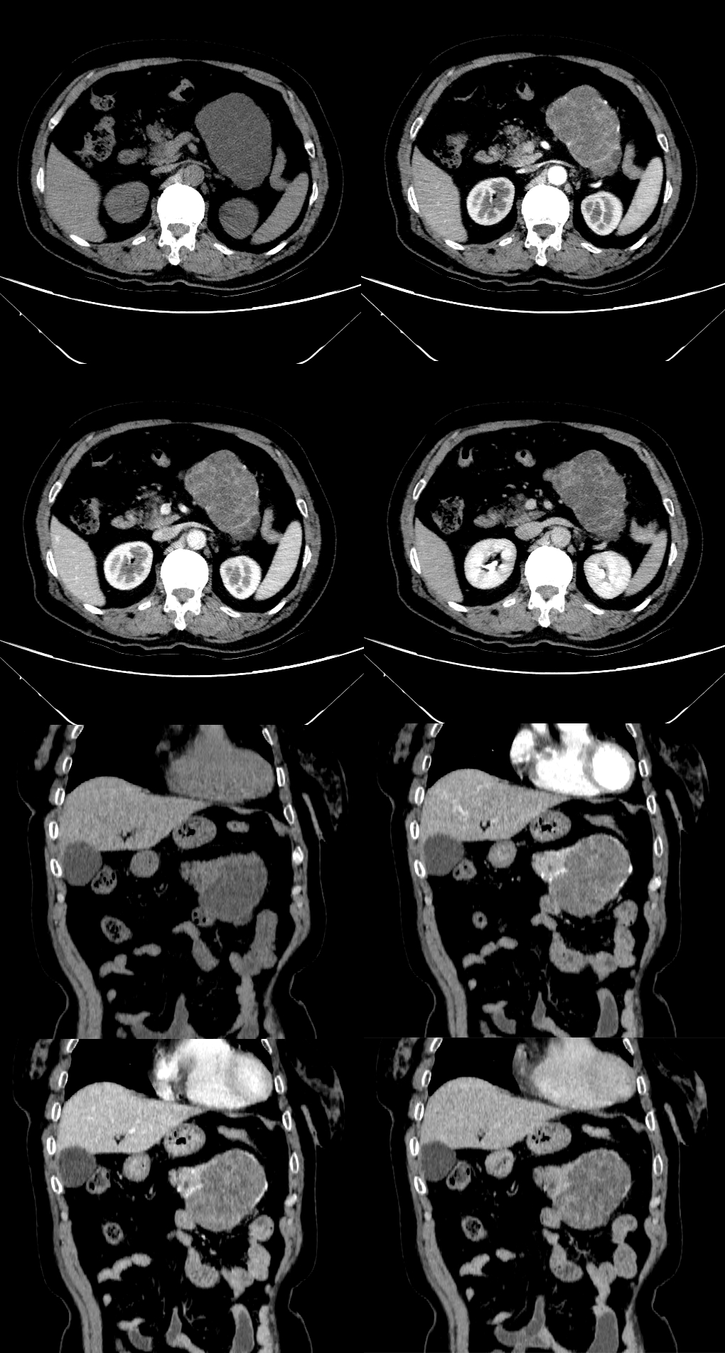 影像PPT - 【病例】典型“奶奶瘤”——胰腺浆液性微囊性腺瘤1例CT-3 影像PPT - 【病例】典型“奶奶瘤”——胰腺浆液性微囊性腺瘤1例CT-3