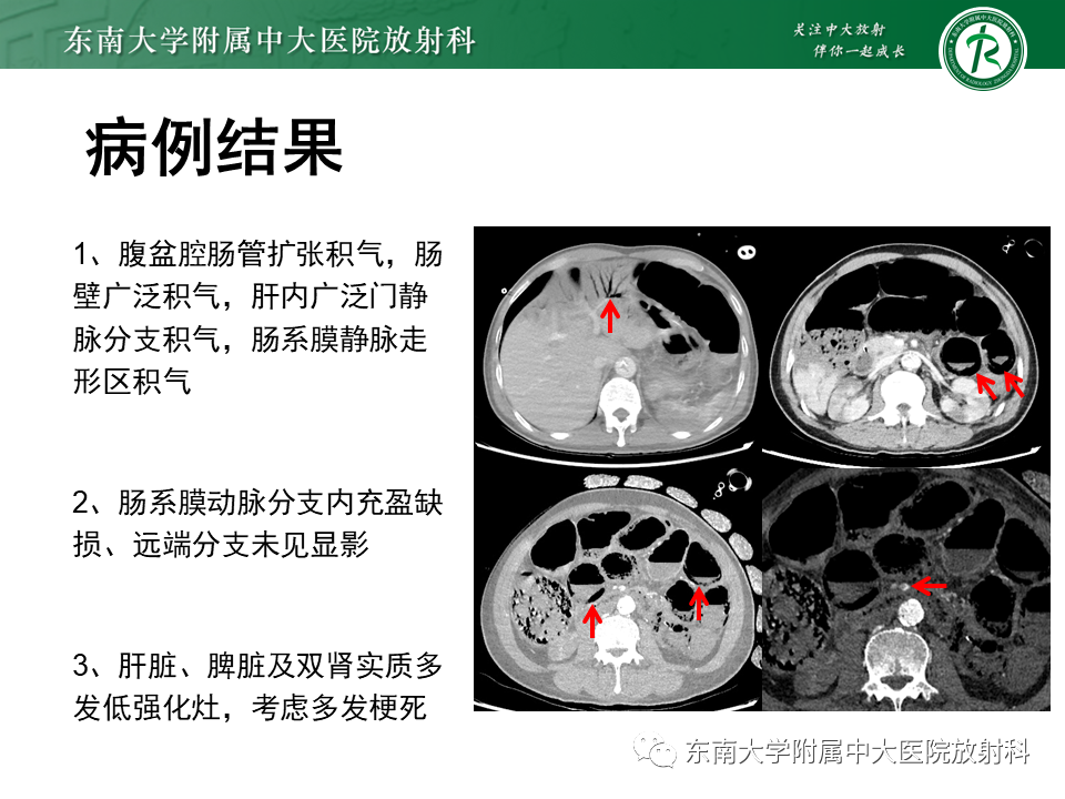 影像PPT - 【PPT】门静脉积气-3 影像PPT - 【PPT】门静脉积气-3