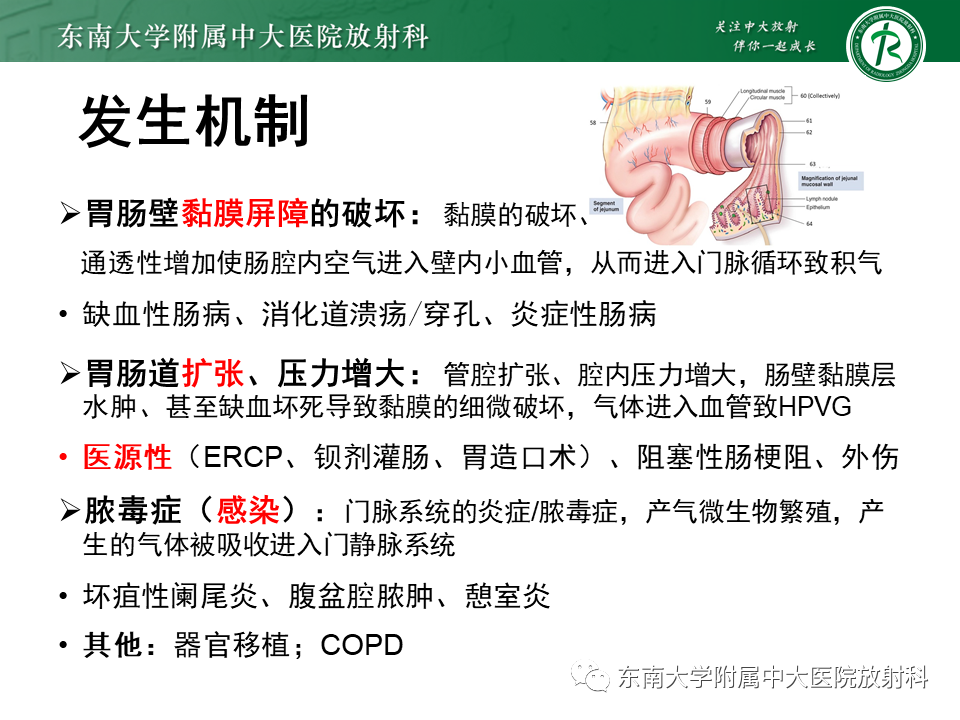 影像PPT - 【PPT】门静脉积气-7 影像PPT - 【PPT】门静脉积气-7