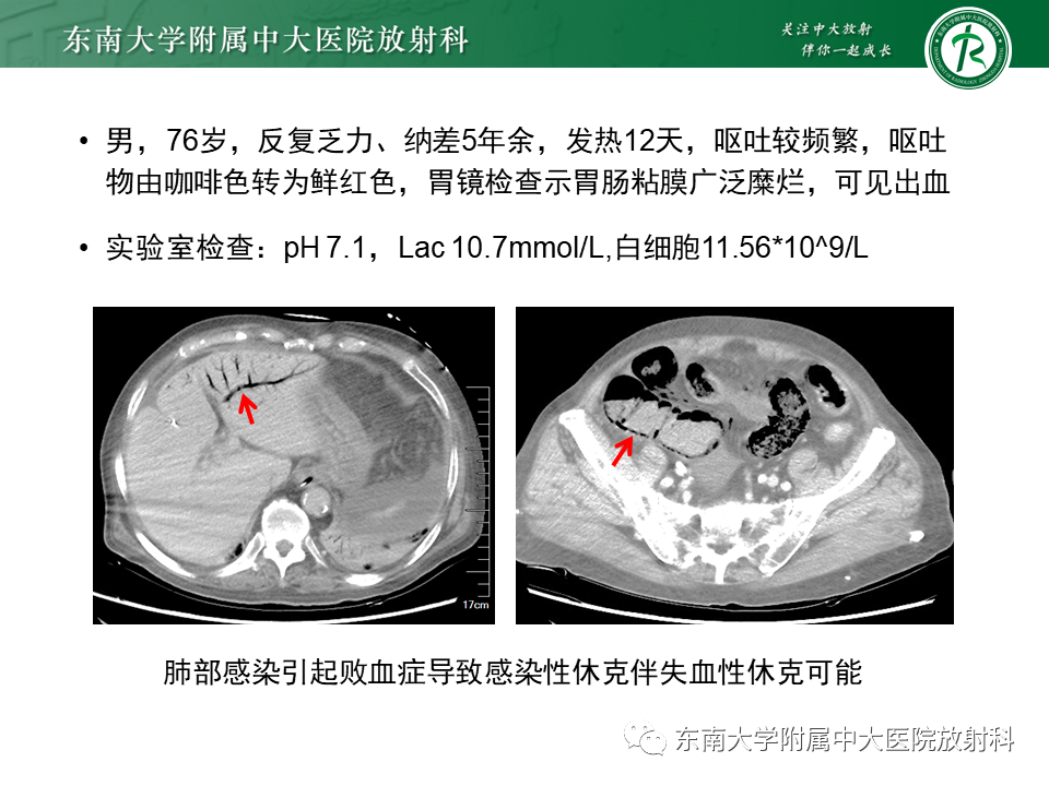 影像PPT - 【PPT】门静脉积气-12 影像PPT - 【PPT】门静脉积气-12