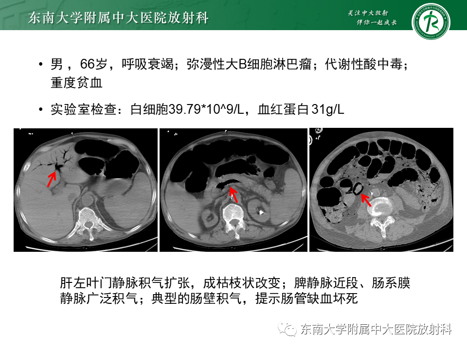 影像PPT - 【PPT】门静脉积气-14 影像PPT - 【PPT】门静脉积气-14