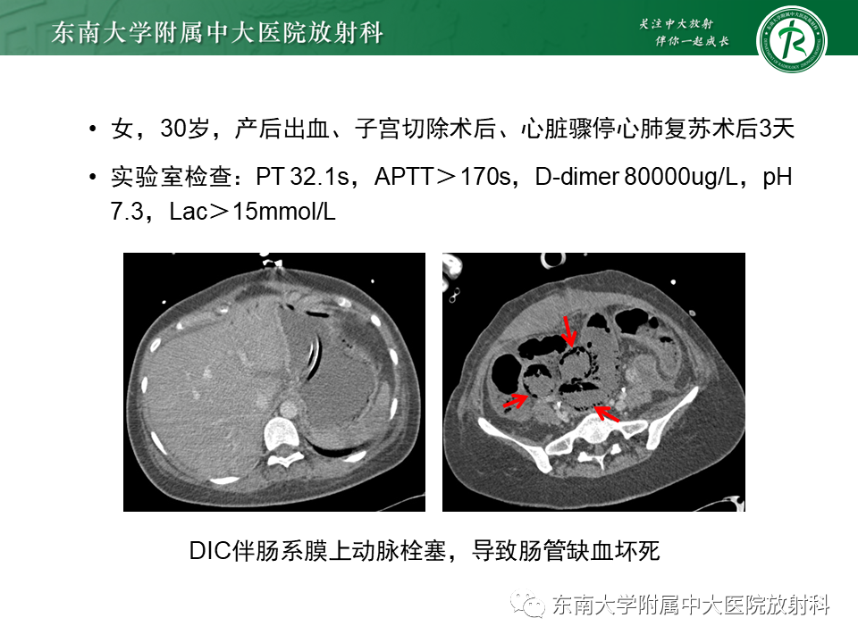 影像PPT - 【PPT】门静脉积气-13 影像PPT - 【PPT】门静脉积气-13