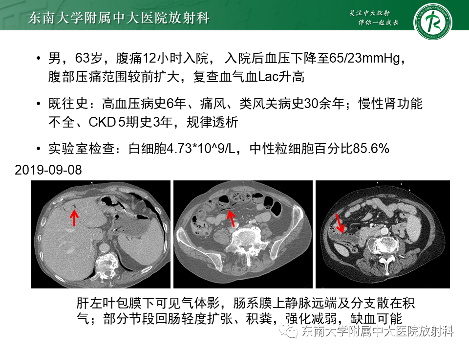 影像PPT - 【PPT】门静脉积气-15 影像PPT - 【PPT】门静脉积气-15