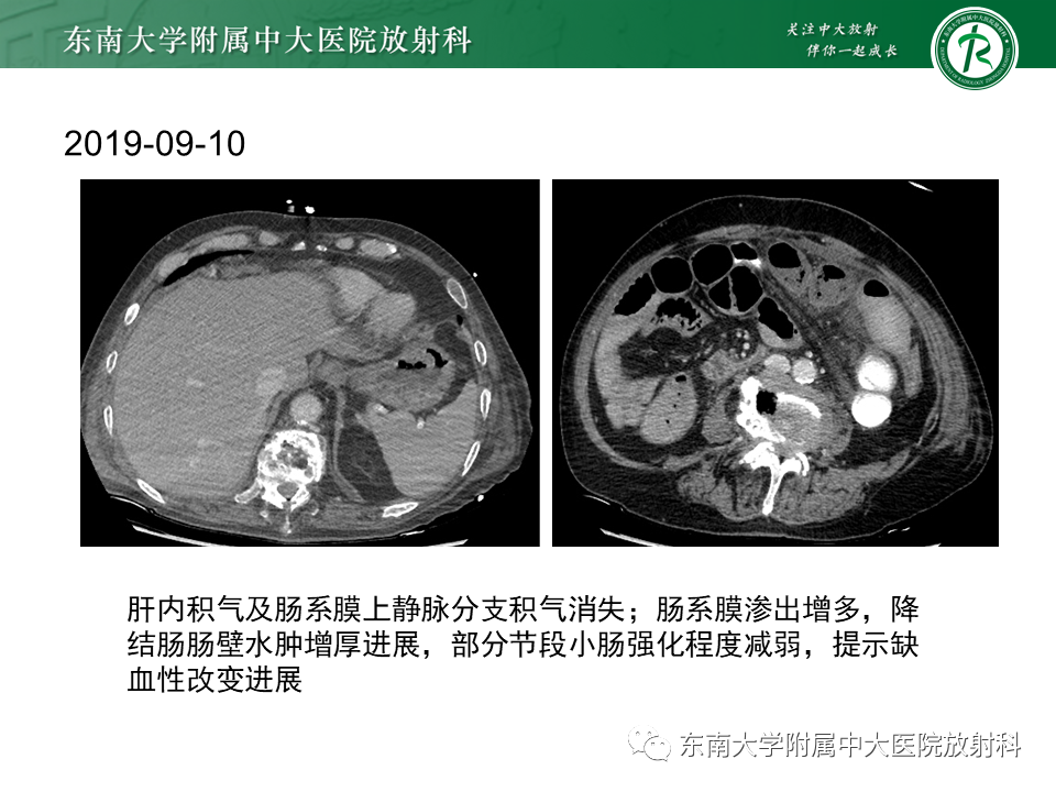 影像PPT - 【PPT】门静脉积气-16 影像PPT - 【PPT】门静脉积气-16