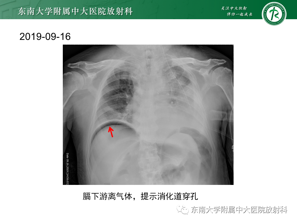 影像PPT - 【PPT】门静脉积气-17 影像PPT - 【PPT】门静脉积气-17