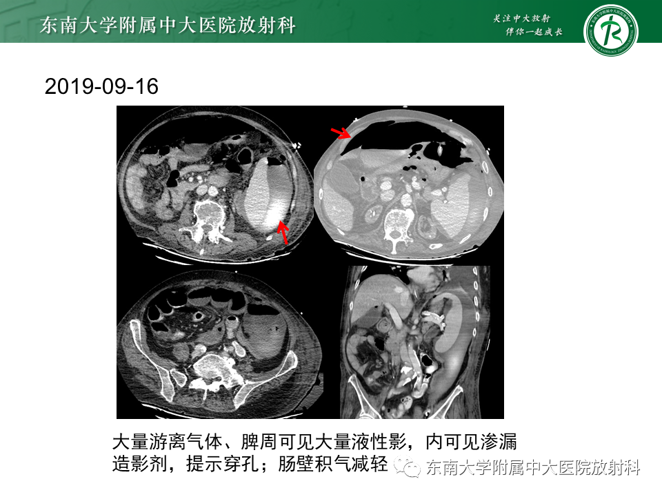 影像PPT - 【PPT】门静脉积气-18 影像PPT - 【PPT】门静脉积气-18