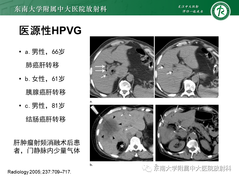 影像PPT - 【PPT】门静脉积气-19 影像PPT - 【PPT】门静脉积气-19