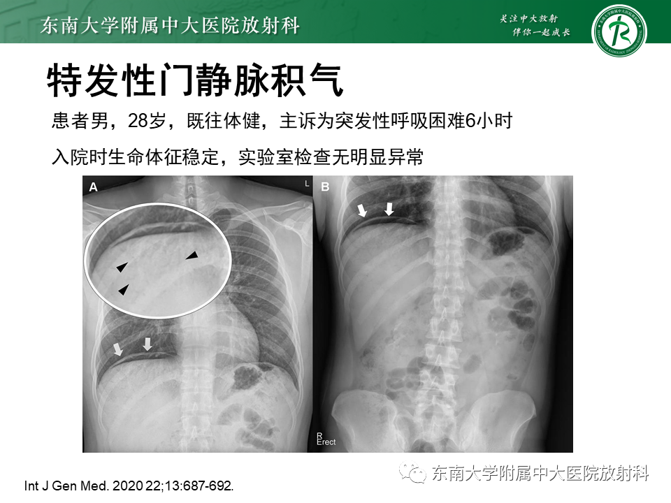 影像PPT - 【PPT】门静脉积气-24 影像PPT - 【PPT】门静脉积气-24