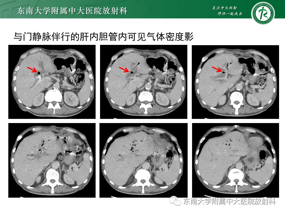 影像PPT - 【PPT】门静脉积气-23 影像PPT - 【PPT】门静脉积气-23