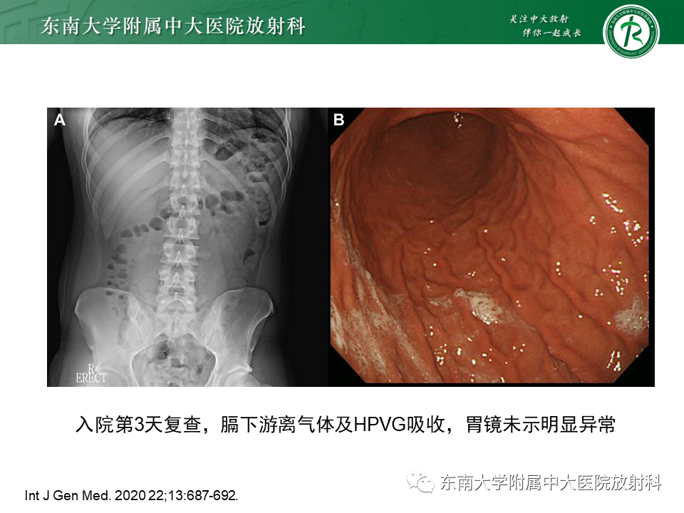 影像PPT - 【PPT】门静脉积气-26 影像PPT - 【PPT】门静脉积气-26