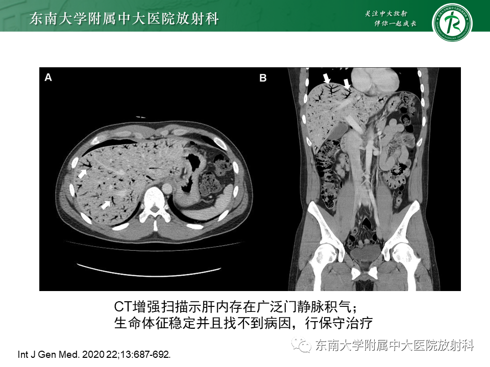 影像PPT - 【PPT】门静脉积气-25 影像PPT - 【PPT】门静脉积气-25
