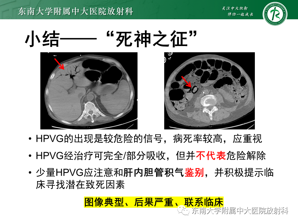 影像PPT - 【PPT】门静脉积气-29 影像PPT - 【PPT】门静脉积气-29