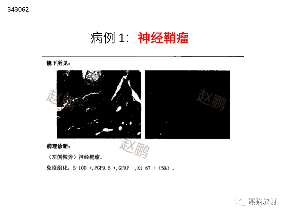 影像PPT - 【PPT】常见鞍旁及海绵窦部位肿瘤MRI诊断-20