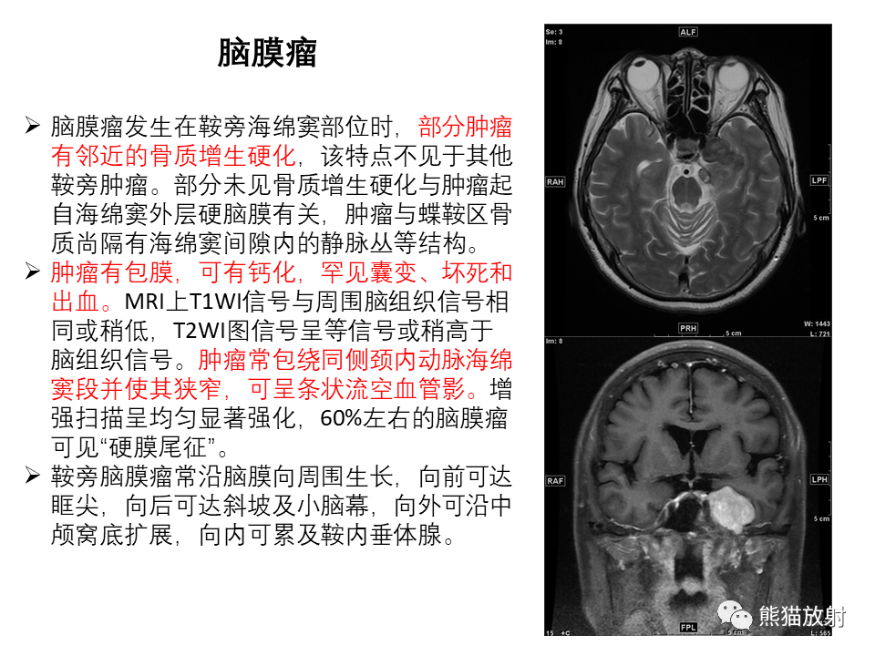影像PPT - 【PPT】常见鞍旁及海绵窦部位肿瘤MRI诊断-24