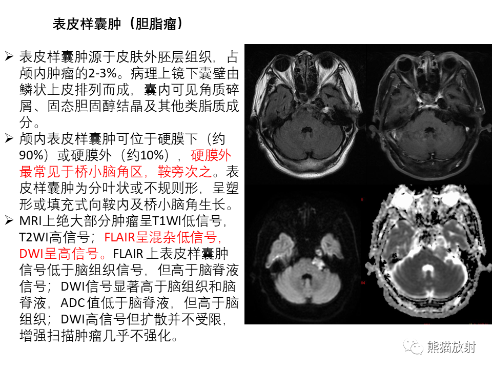 影像PPT - 【PPT】常见鞍旁及海绵窦部位肿瘤MRI诊断-25