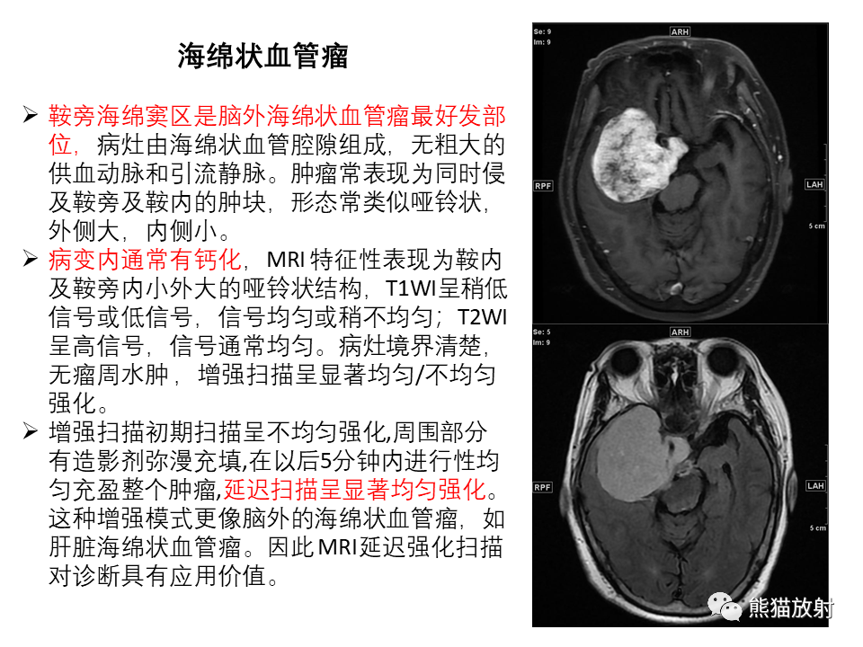 影像PPT - 【PPT】常见鞍旁及海绵窦部位肿瘤MRI诊断-26