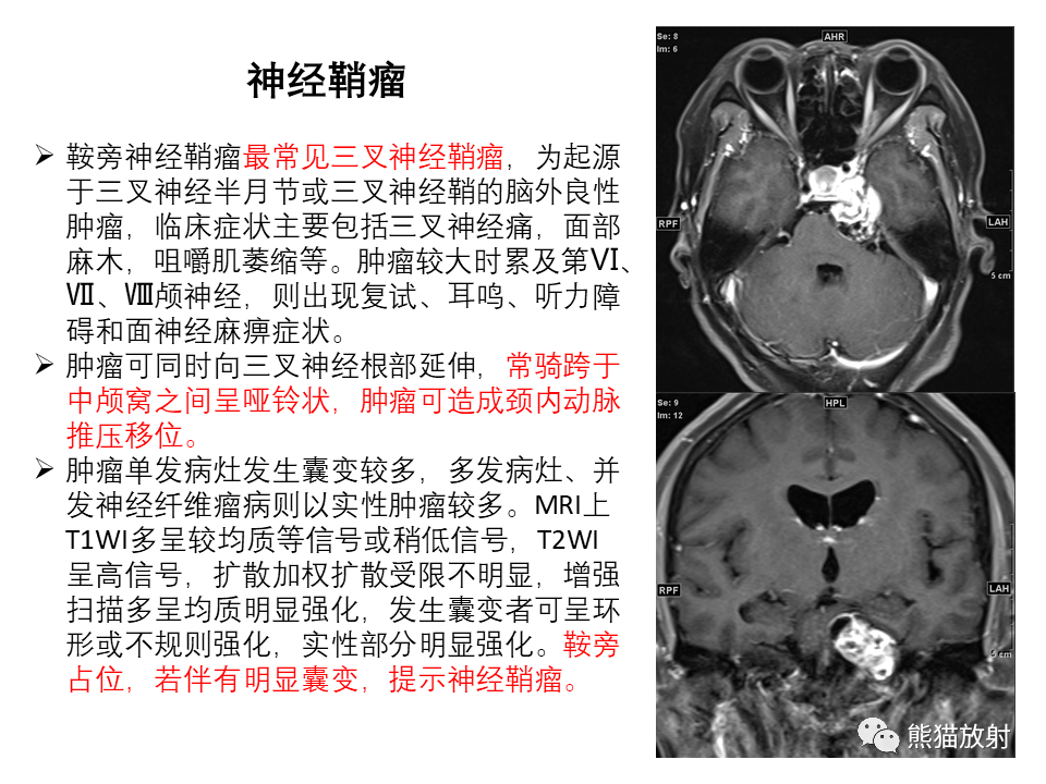 影像PPT - 【PPT】常见鞍旁及海绵窦部位肿瘤MRI诊断-27