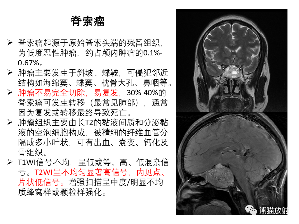 影像PPT - 【PPT】常见鞍旁及海绵窦部位肿瘤MRI诊断-28