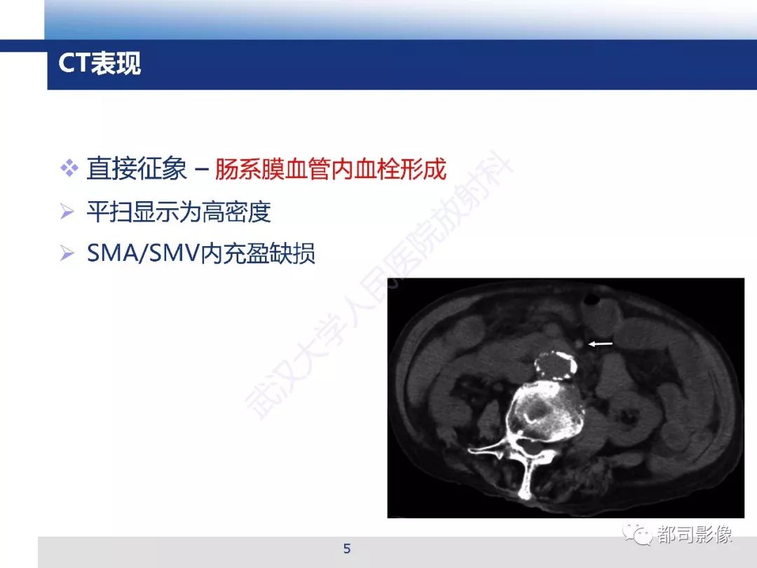 影像PPT - 【PPT】急性肠系膜血管缺血的CT诊断及介入治疗-5