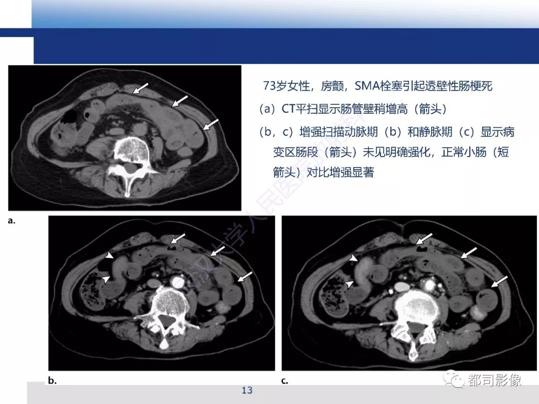 影像PPT - 【PPT】急性肠系膜血管缺血的CT诊断及介入治疗-13