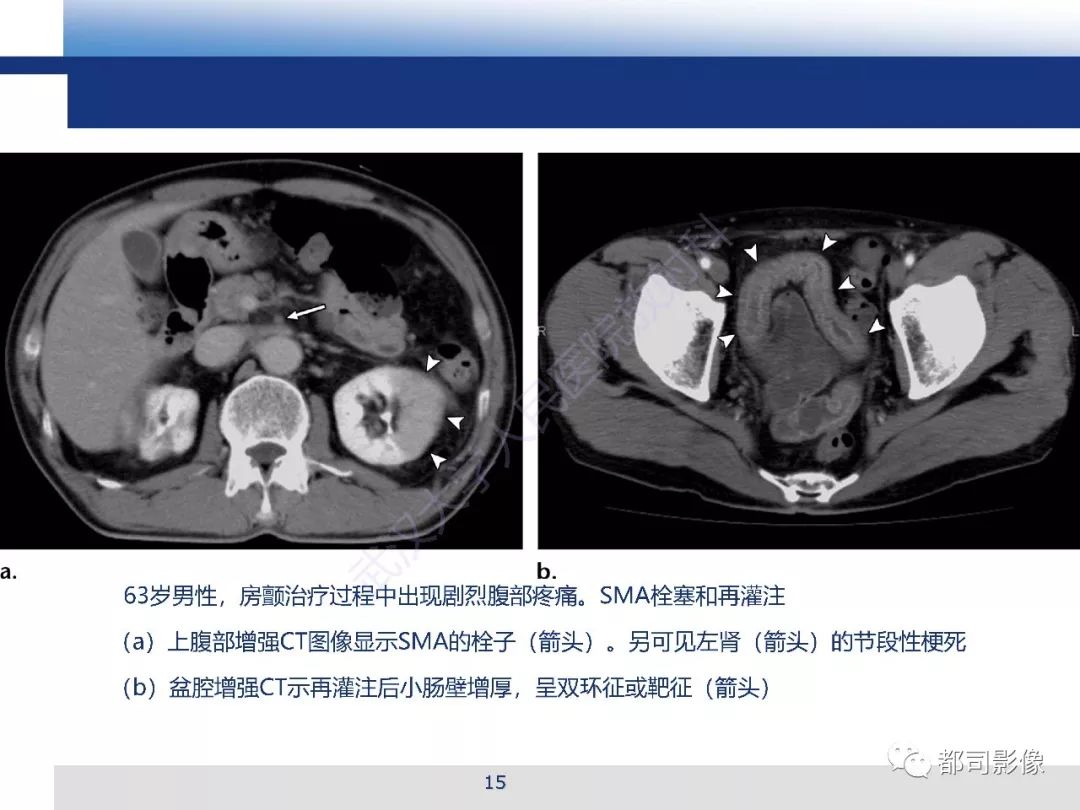 影像PPT - 【PPT】急性肠系膜血管缺血的CT诊断及介入治疗-15