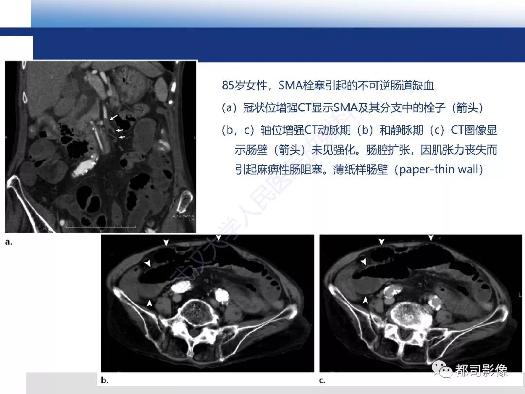 影像PPT - 【PPT】急性肠系膜血管缺血的CT诊断及介入治疗-16