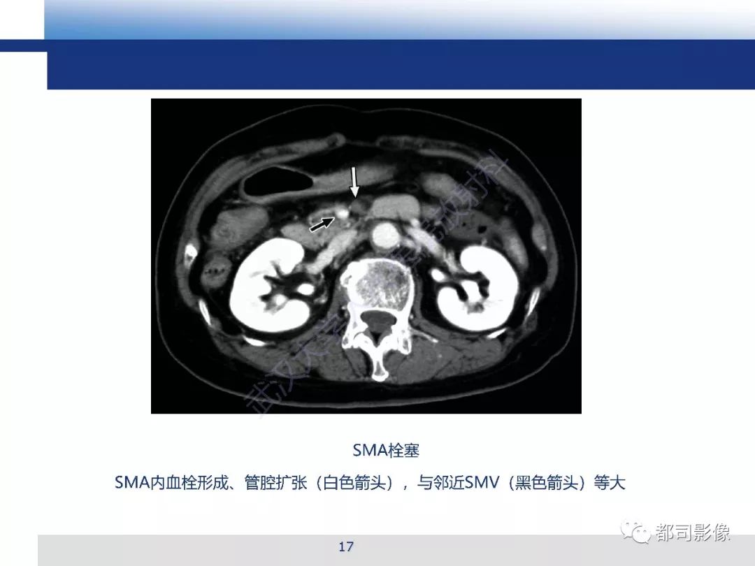 影像PPT - 【PPT】急性肠系膜血管缺血的CT诊断及介入治疗-17