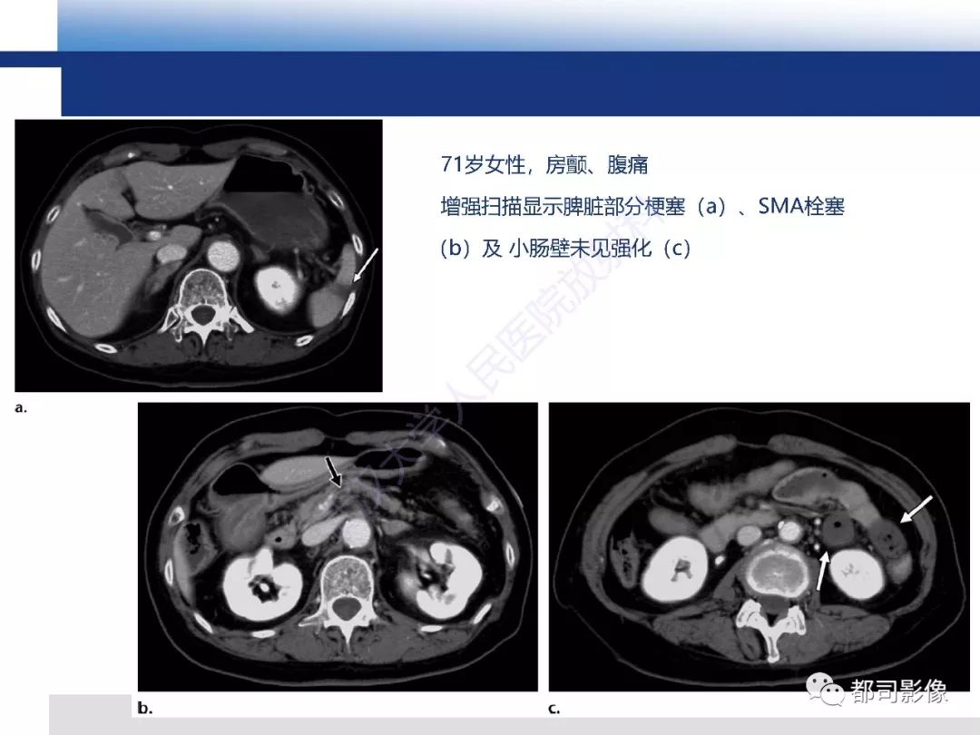 影像PPT - 【PPT】急性肠系膜血管缺血的CT诊断及介入治疗-14