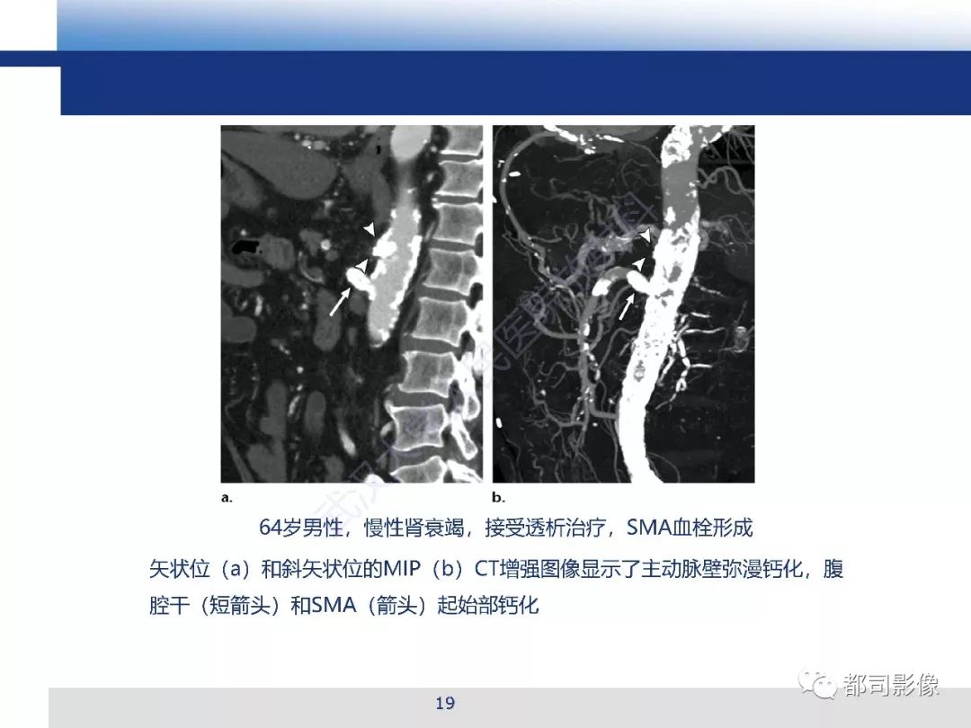 影像PPT - 【PPT】急性肠系膜血管缺血的CT诊断及介入治疗-19