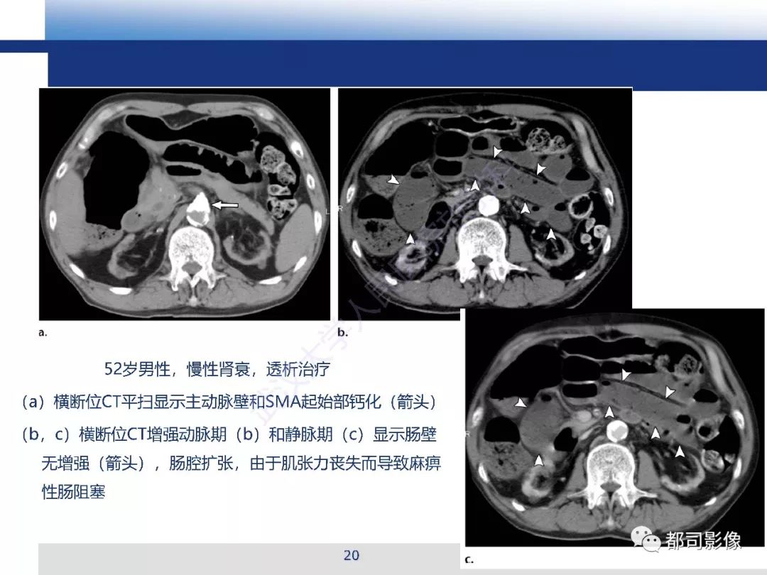 影像PPT - 【PPT】急性肠系膜血管缺血的CT诊断及介入治疗-20