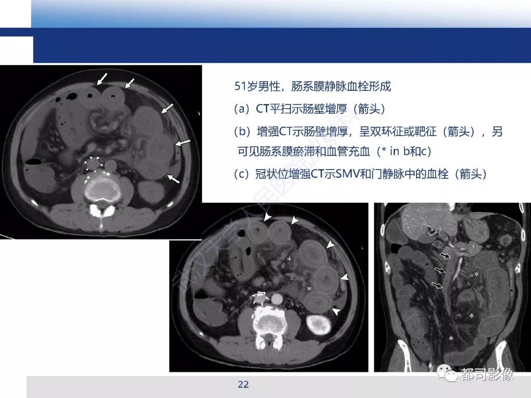 影像PPT - 【PPT】急性肠系膜血管缺血的CT诊断及介入治疗-22