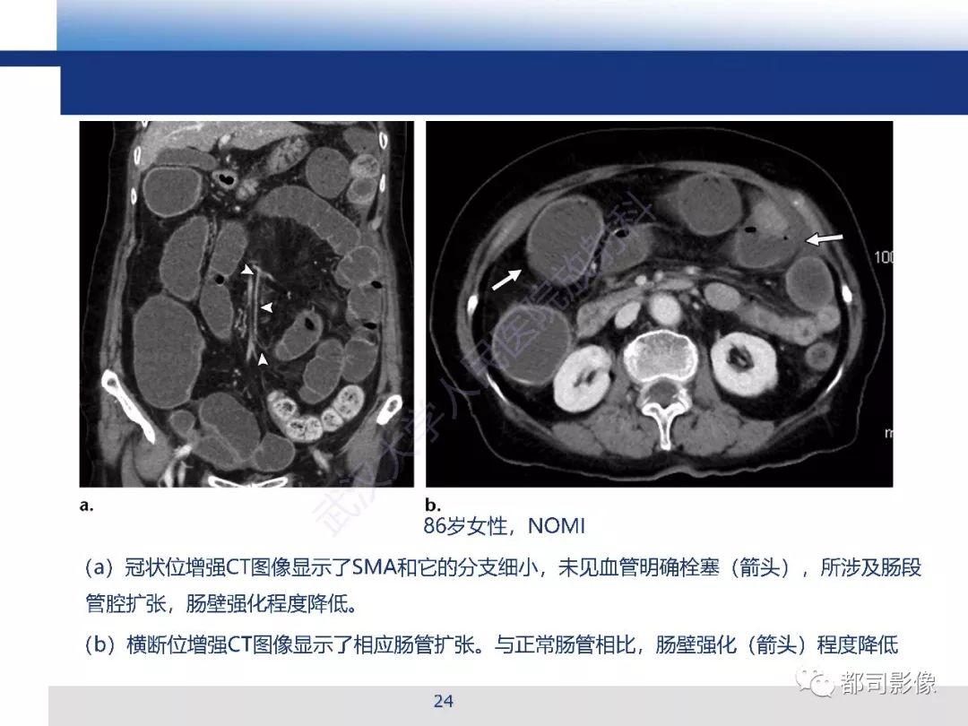影像PPT - 【PPT】急性肠系膜血管缺血的CT诊断及介入治疗-24