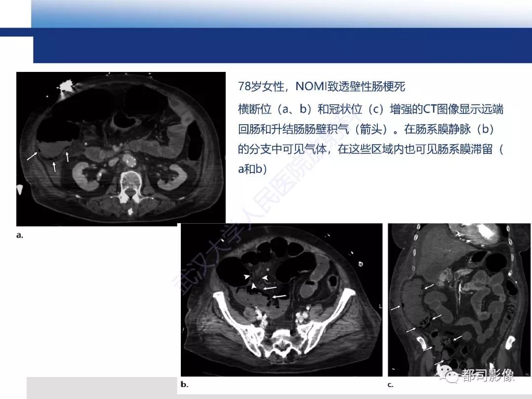 影像PPT - 【PPT】急性肠系膜血管缺血的CT诊断及介入治疗-25