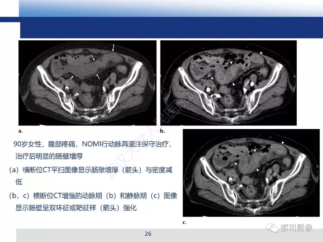 影像PPT - 【PPT】急性肠系膜血管缺血的CT诊断及介入治疗-26