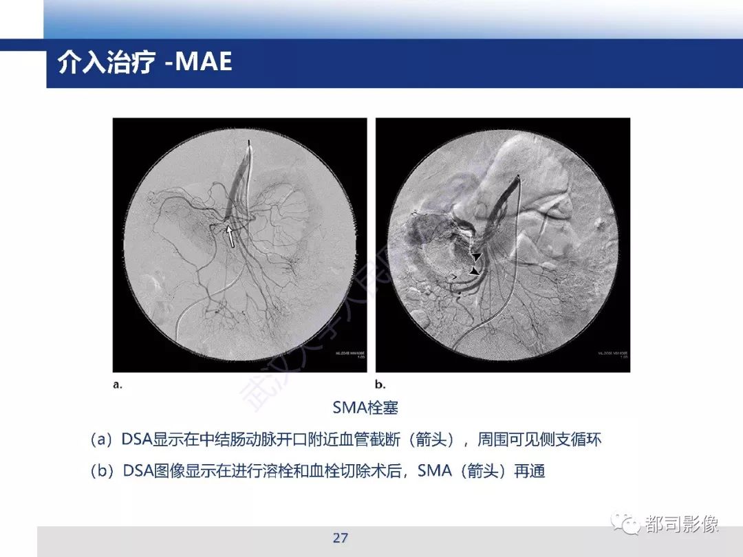 影像PPT - 【PPT】急性肠系膜血管缺血的CT诊断及介入治疗-27