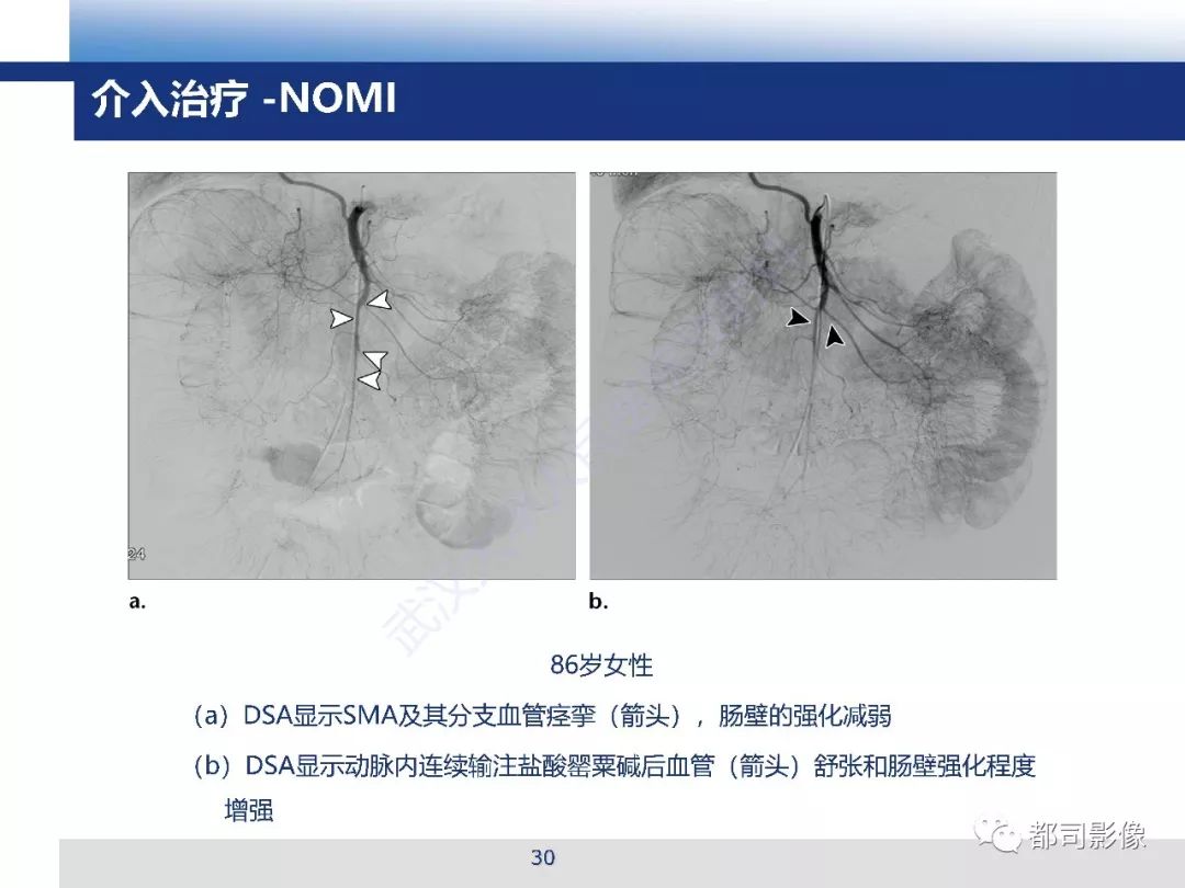 影像PPT - 【PPT】急性肠系膜血管缺血的CT诊断及介入治疗-30