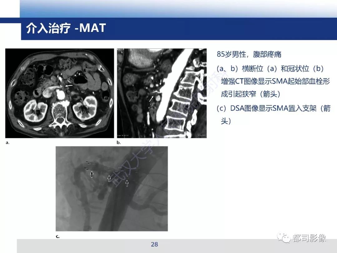 影像PPT - 【PPT】急性肠系膜血管缺血的CT诊断及介入治疗-28