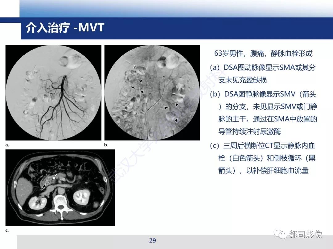影像PPT - 【PPT】急性肠系膜血管缺血的CT诊断及介入治疗-29