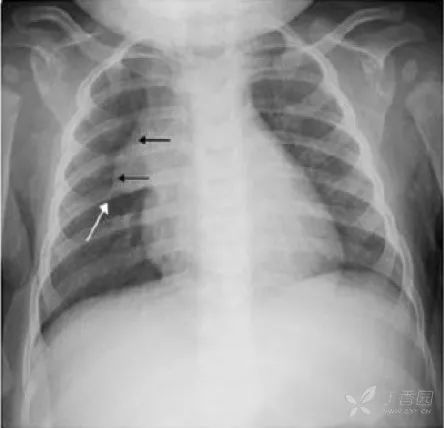 影像PPT - 3 大征象、12 张图片教你认识胸腺X线影像-3 影像PPT - 3 大征象、12 张图片教你认识胸腺X线影像-3