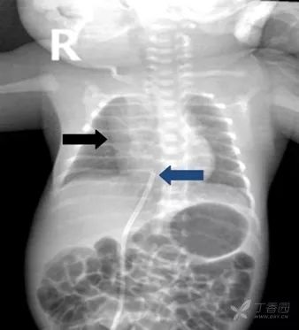 影像PPT - 3 大征象、12 张图片教你认识胸腺X线影像-13 影像PPT - 3 大征象、12 张图片教你认识胸腺X线影像-13