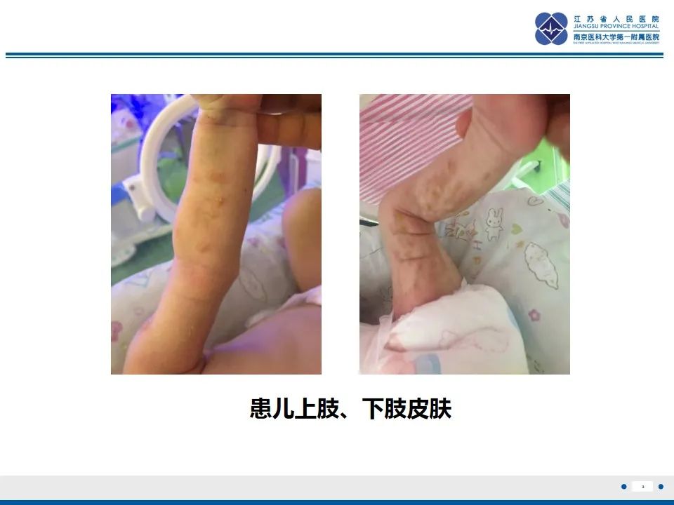 影像PPT - 【PPT】色素失禁症的影像表现-5