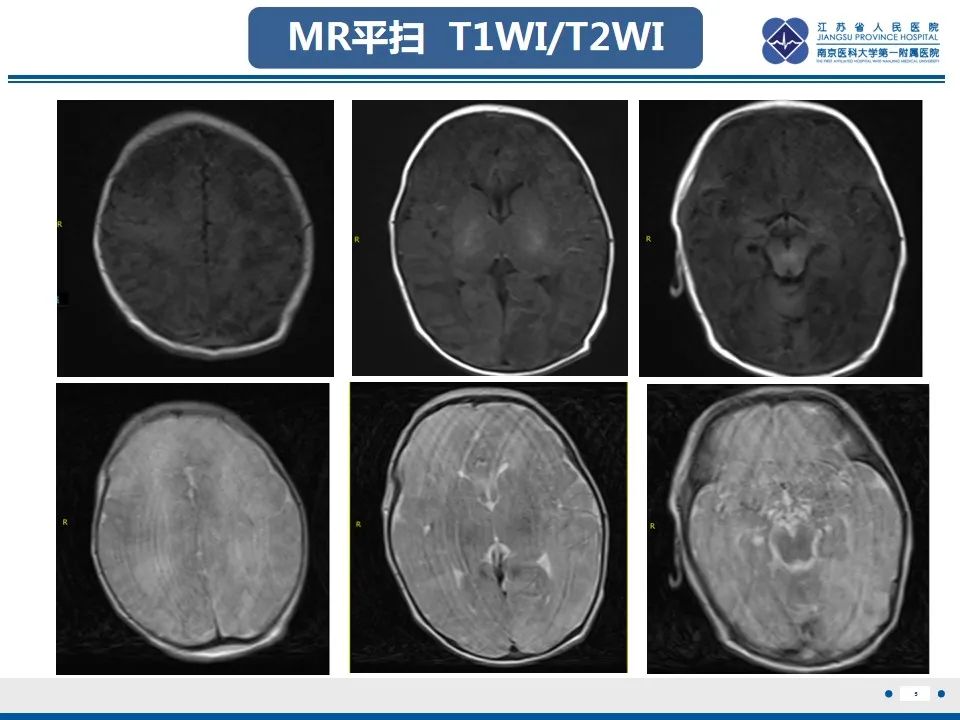 影像PPT - 【PPT】色素失禁症的影像表现-7