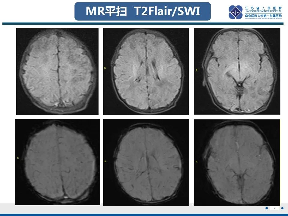 影像PPT - 【PPT】色素失禁症的影像表现-8