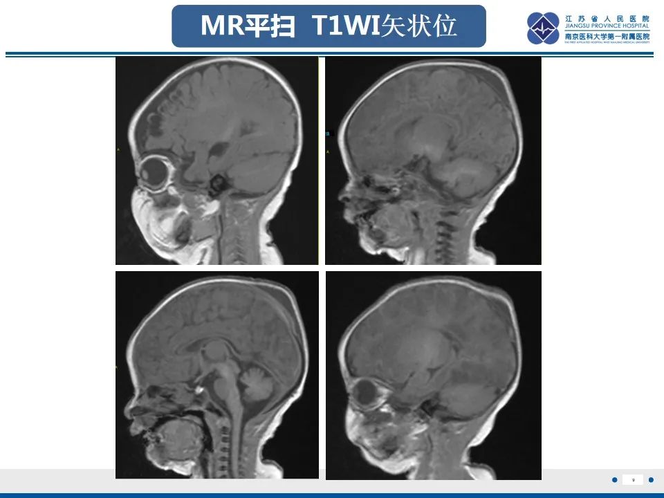 影像PPT - 【PPT】色素失禁症的影像表现-11
