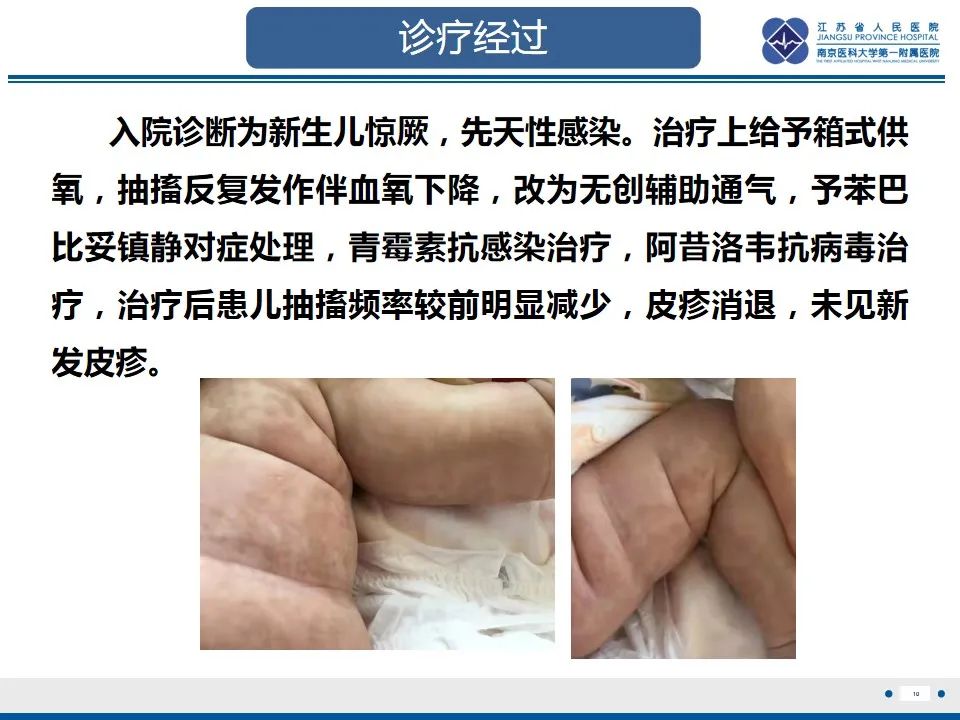 影像PPT - 【PPT】色素失禁症的影像表现-12