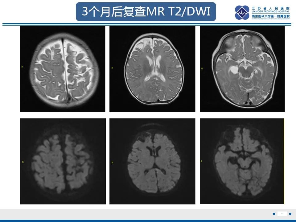 影像PPT - 【PPT】色素失禁症的影像表现-13
