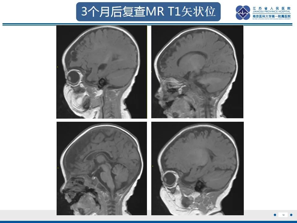 影像PPT - 【PPT】色素失禁症的影像表现-14